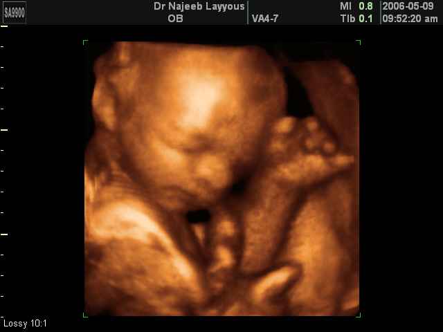 Terhességi ultrahang